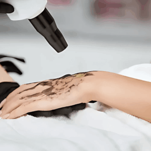 Carbon+Picolaser Treatment - Other Body Part