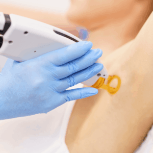 Carbon+Picolaser Treatment - Underarm Whtening