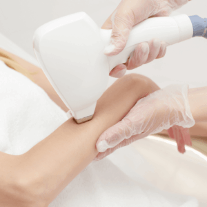 Diode - Full Arm Hair Removal