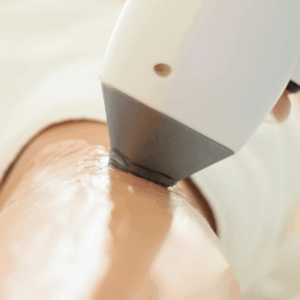 Diode - Full Leg Hair Removal