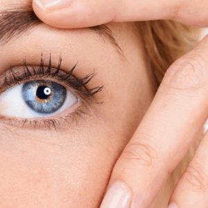 Fibroblast Crow's Feet Reduction