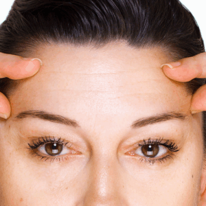 Fibroblast Forehead Wrinkle Treatment