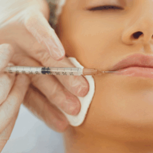 Fibroblast Lip Line Reduction