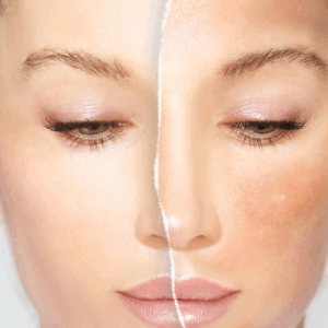 Meso Skin Treatment - Melasma Lightening
